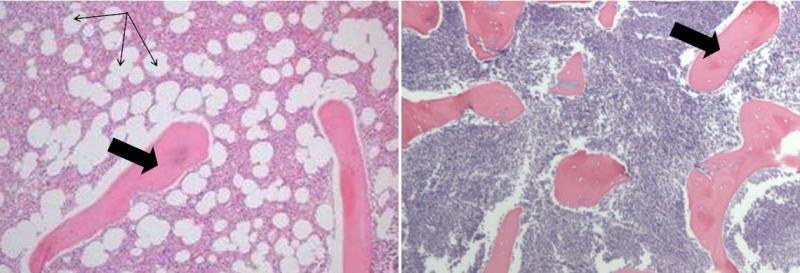 Sezione midollare. Visibili struttura e vari componenti midollari. A sinistra un midollo normale. A destra la biopsia di un paziente leucemico (cellule leucemiche scure per la presenza di grossi nuclei). Fonte: Chuanyi Mark Lu MD, PhD e Karen Chisholm MD