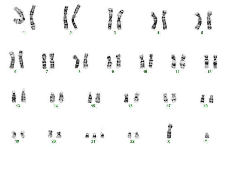 Esempio di cariotipo anomalo con cromosoma sovrannumerario (Trisomia 21). Concessione di: Mary Lowery Nordberg, PhD 