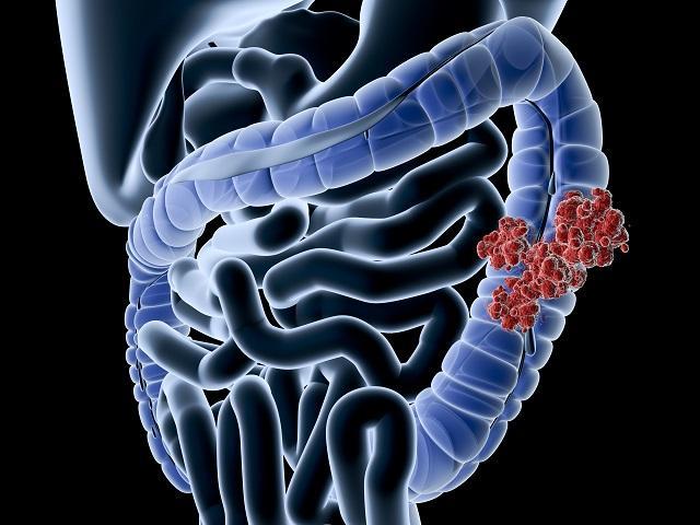 Il tumore al colon-retto rappresenta il secondo tumore più diagnosticato nella popolazione italiana
