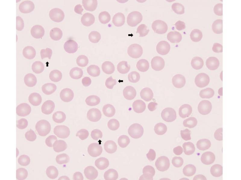 La carenza di G6PD è una patologia in grado di formare le “cellule dentellate”, visibili allo striscio di sangue periferico. Fonte immagine: Chuanyi Mark Lu, MD, PhD