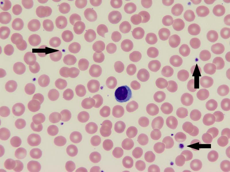 Le frecce indicano le piastrine, che appaiono come piccoli frammenti di cellule viola quando si esamina uno striscio di sangue al microscopio. Courtesy Bette Jamieson, MEd