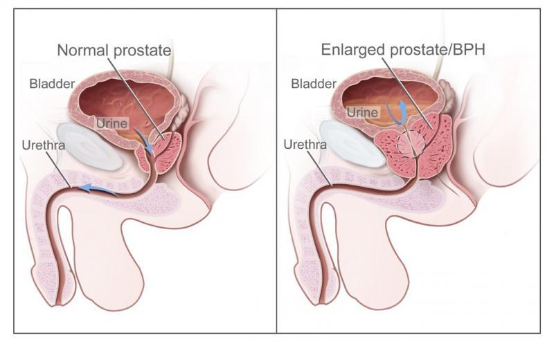 Anche l'iperplasia prostatica benigna può causare un innalzamento del PSA. Fonte immagine: Alan Hoofring, NCI