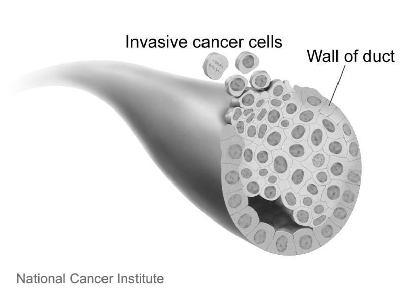 Cellule di carcinoma mammario invasive, in grado di crescere al di fuori della parete del dotto (wall of duct). Fonte immagine: Don Bliss, NCI