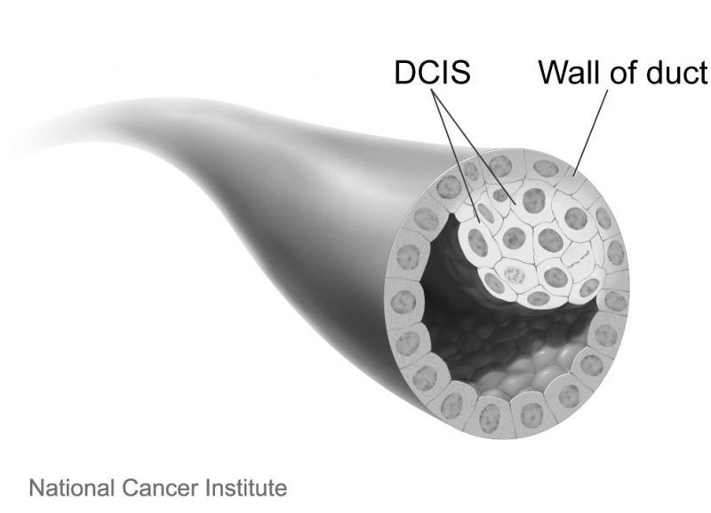 Dotto mammario con carcinoma in situ. Fonte immagine: Don Bliss, NCI