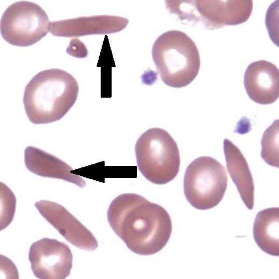 Eritrociti falciformi in uno striscio di sangue. Fonte immagine: Bette Jamieson
